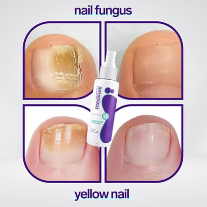 Nail Fungus